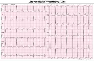 ECG Left Ventricular Hypertrophy (LVH) - Left Ventricular Enlargement - 12 Lead ECG Common Case - 6 Sec/lead - Vector Illustration