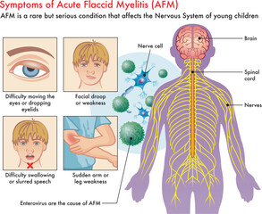 Medical illustration of Symptoms of Acute Flaccid Myelitis (AFM), with annotations.