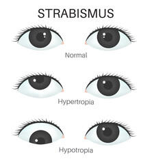 Types of strabismus- Hypertropia and Hypotopia.