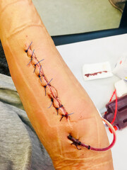 Wundnaht nach einer Unterarm Operation