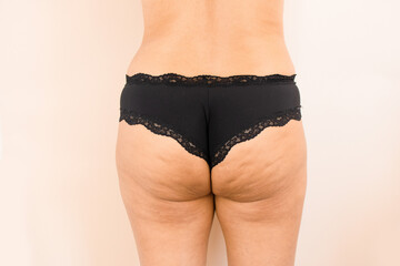 Female Bottom Woman with Cellulite Dimples Hips