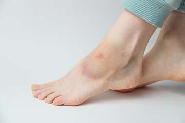 Sprained ankle with bruise and swelling on a female left foot on white background