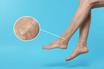 Woman suffering from varicose veins on light blue background, closeup. Magnified skin surface...