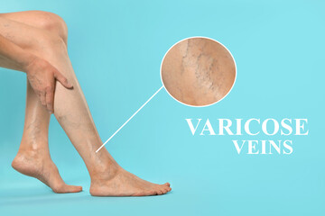Woman suffering from varicose veins on light blue background, closeup. Magnified skin surface...