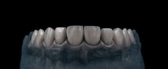 emax ceramic veneers b1 color