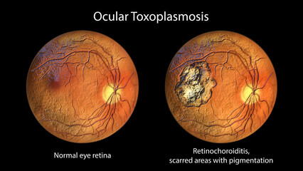 Retinal scar caused by a Toxoplasma gondii infection, or toxoplasmosis, and the same healthy eye retina for comparison, 3D illustration