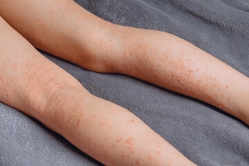 An approximate image of legs with pigmented porphyria lying on a gray blanket. A part of the human...