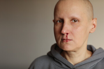 Young bald cancer sick woman is bleeding from her nose, effects of chemotherapy. Female lost her...
