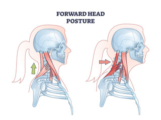 Forward head posture compared with healthy neck position outline diagram. Educational scheme with turtle neck condition and muscular system vector illustration. Anatomical spine problem explanation. - obrazy, fototapety, plakaty