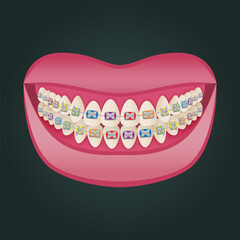 The concept of teeth alignment with braces. Orthodontic dentistry. The alignment of the teeth. Beautiful white teeth. Isolated flat vector illustration. Simple teeth in a row. Orthodontic treatment.