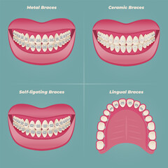 The concept of teeth alignment with braces. Orthodontic dentistry. The alignment of the teeth. Beautiful white teeth. Isolated flat vector illustration. Simple teeth in a row. Orthodontic treatment.