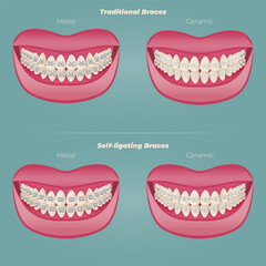 The concept of teeth alignment with braces. Orthodontic dentistry. The alignment of the teeth. Beautiful white teeth. Isolated flat vector illustration. Simple teeth in a row. Orthodontic treatment.