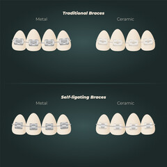 The concept of teeth alignment with braces. Orthodontic dentistry. The alignment of the teeth. Beautiful white teeth. Isolated flat vector illustration. Simple teeth in a row. Orthodontic treatment.