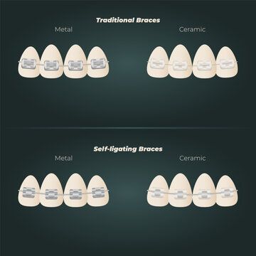 The concept of teeth alignment with braces. Orthodontic dentistry. The alignment of the teeth. Beautiful white teeth. Isolated flat vector illustration. Simple teeth in a row. Orthodontic treatment.