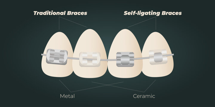 The concept of teeth alignment with braces. Orthodontic dentistry. The alignment of the teeth. Beautiful white teeth. Isolated flat vector illustration. Simple teeth in a row. Orthodontic treatment.