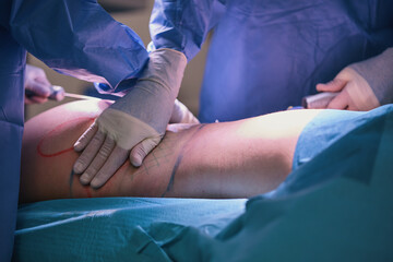 High definition liposuction in the operating room, plastic surgeons