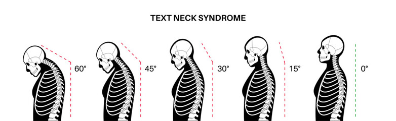 Neck vertebrae deformity - obrazy, fototapety, plakaty