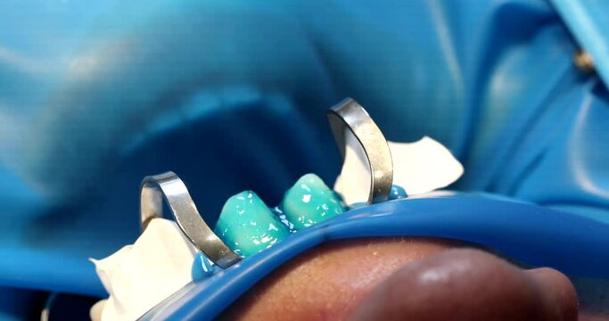 Dentist applies blue gel to tooth before installing veneers closeup. Quality dental veneers