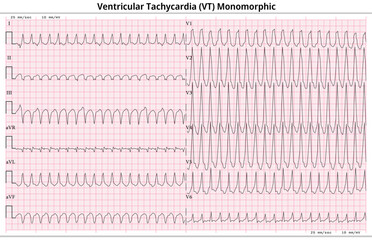 ECG Ventricular Tachycardia Monomorphic - 12 Lead ECG Common Case - 6 Sec - Vector Illustration