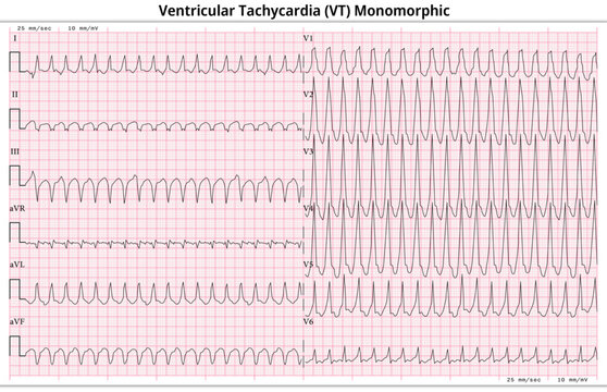 ECG Ventricular Tachycardia Monomorphic - 12 Lead ECG Common Case - 6 Sec - Vector Illustration
