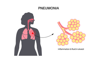 Pneumonia infection poster