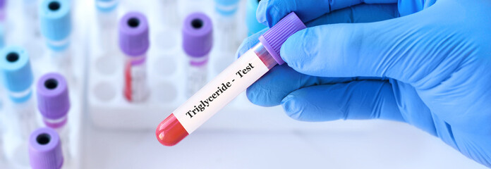 Doctor holding a test blood sample tube with Triglyceride test on the background of medical test...