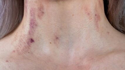 A woman's neck with traces of violence. Bruises and abrasions. The concept of women's freedom and...