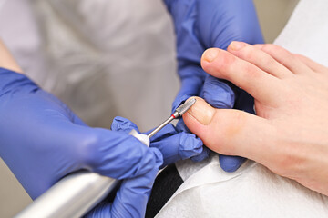 Hardware medical pedicure with a drill and nail files. A patient on a pedicure with a podiatrist....