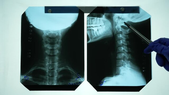 X-ray of the cervical spine. Doctor explains problems in the vertebrae by showing on snapshot
