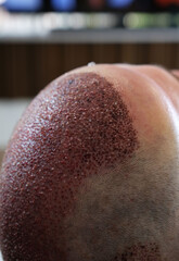 Close up after hair transplant operation.