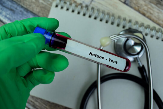 Concept Of Ketone - Test With Blood Sample. Healthcare Or Medical Concept