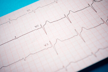 Electrocardiogram printed on paper on a blue table.