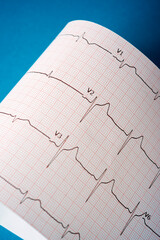 Electrocardiogram printed on paper on a blue table.