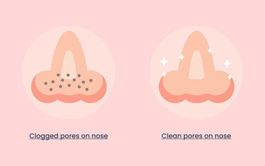 Clogged pores and clean pores on nose. hygiene concept. vector illustration.