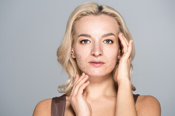 Portrait of blonde model with skin issue touching face isolated on grey.