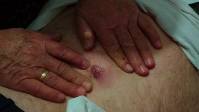 There is a large pimple on the man's back. The woman is squeezing the pimple and pus is coming out.