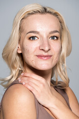 Portrait of smiling woman with acne on face touching shoulder isolated on grey.