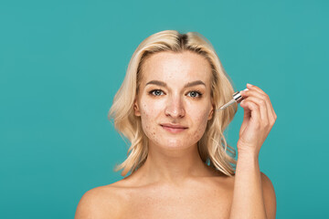 blonde woman with acne on face holding pipette with moisturizing serum isolated on turquoise.