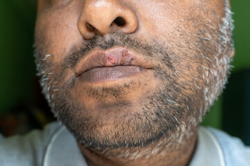 Close up a virus herpes on men's lips. A cold sore on the lip of a middle-aged male. Fever blisters