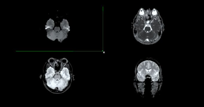 Magnetic resonance imaging of the brain or MRI brain for diagnosis stroke diseases. Stroke Protocol.