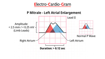 P Wave - P Mitrale - ECG Left Atrial Enlargement/Hypertrophy - Electrocardiogram - Morphology P Wave - Vector Illustration