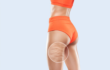 A woman in orange underwear with cellulite on her legs. Obese woman. Overweight treatment. Photo before and after weight loss. - obrazy, fototapety, plakaty