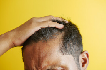 Fototapeta premium hair loss concept with man checking his hair 