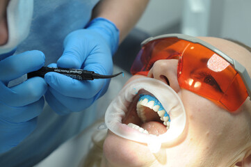 there is a preparation of the oral cavity to bleaching with the help of an ultraviolet lamp. liquid cofferdam to isolate the gums from the action of a bleaching agent optragat rotary spreader