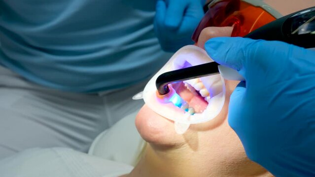 optragate mouth expander Be H3althy Dentist doctor illuminates filling with modern lamp in closeup of clinic. High quality 4k footage