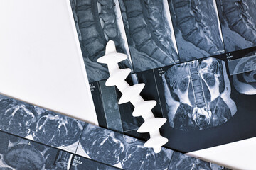 Magnetic resonance imaging of spine with spine model