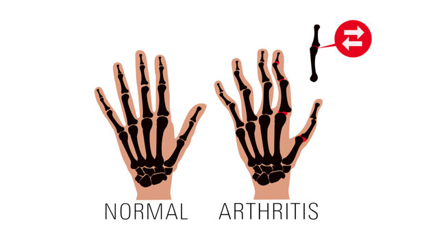 Arthritis illustration