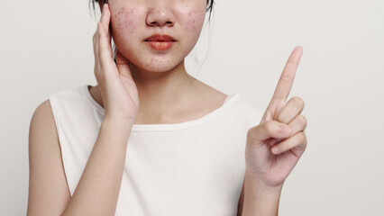 Asian teenage with acne face skin problem, Dermatological disease, white background.