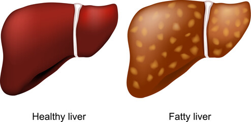 fatty liver disease. Healthy liver and hepatic steatosis. - obrazy, fototapety, plakaty