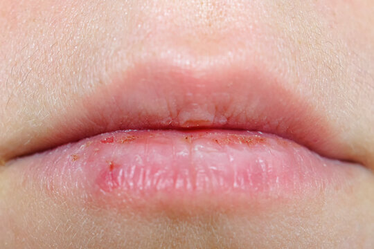 Macro lips with severely dry bleeding cracked or chapped lips. close up